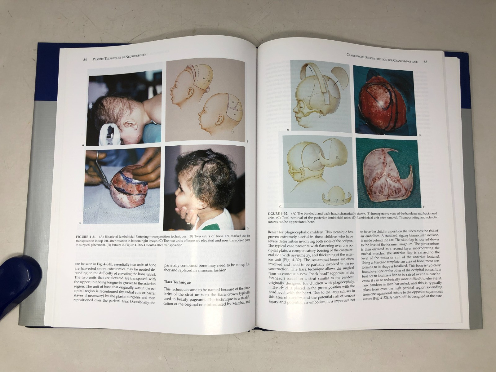 Plastic Techniques in Neurosurgery, 2004, E-122