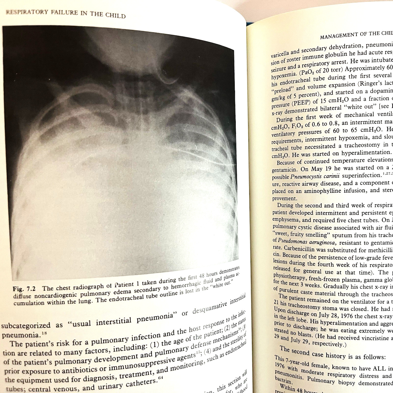 Vintage Respiratory Failure the Child Book Hardcover Churchill Livingstone 1981